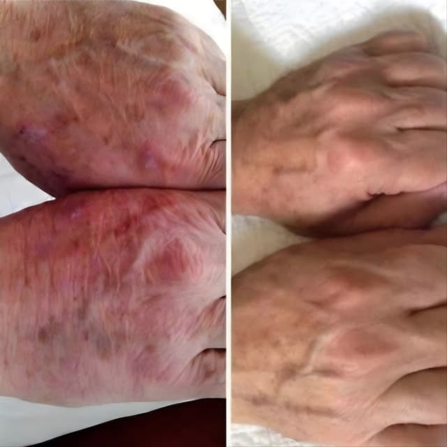 Hand rejuvenation with procell 